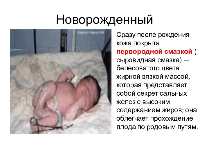 Новорожденный Сразу после рождения кожа покрыта первородной смазкой ( сыровидная смазка) —