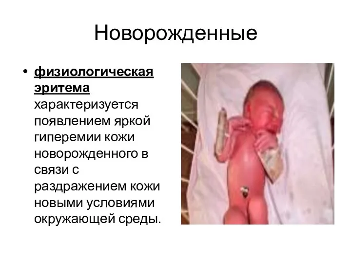 Новорожденные физиологическая эритема характеризуется появлением яркой гиперемии кожи новорожденного в связи с