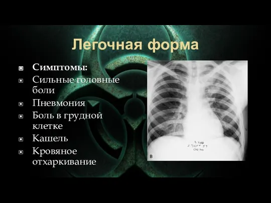 Легочная форма Симптомы: Сильные головные боли Пневмония Боль в грудной клетке Кашель Кровяное отхаркивание