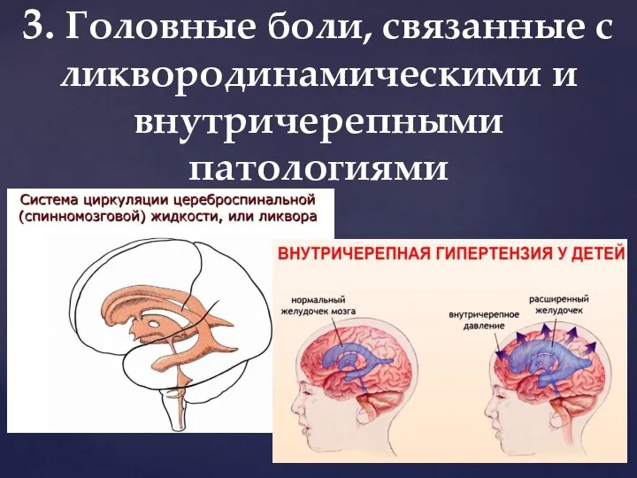 3. Головные боли, связанные с ликвородинамическими и внутричерепными патологиями