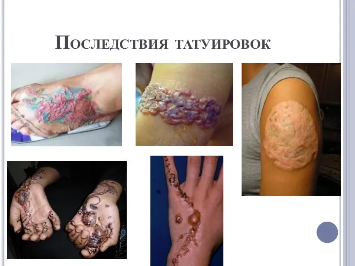 Последствия татуировок