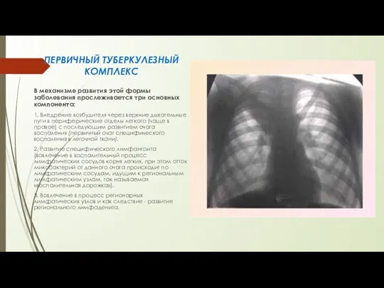 ПЕРВИЧНЫЙ ТУБЕРКУЛЕЗНЫЙ КОМПЛЕКС В механизме разви­тия этой формы заболевания прослеживается три основных