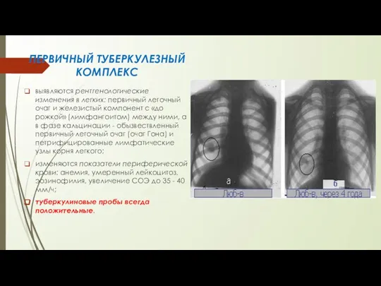 ПЕРВИЧНЫЙ ТУБЕРКУЛЕЗНЫЙ КОМПЛЕКС выявляются рентгенологические изменения в легких: пер­вичный легочный очаг и