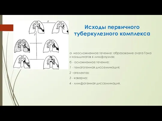 Исходы первичного туберкулезного комплекса а- неосложненное течение: образование очага Гона и кальцинатов