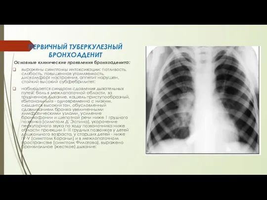 ПЕРВИЧНЫЙ ТУБЕРКУЛЕЗНЫЙ БРОНХОАДЕНИТ Основные клинические проявления бронхоаденита: выражены симптомы интоксикации: потливость, сла­бость,