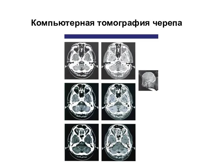 Компьютерная томография черепа