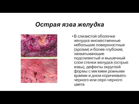 Острая язва желудка В слизистой оболочке желудка множественные небольшие поверхностные (эрозии) и