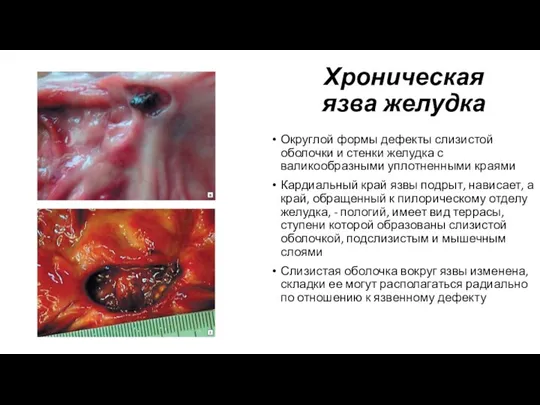 Хроническая язва желудка Округлой формы дефекты слизистой оболочки и стенки желудка с