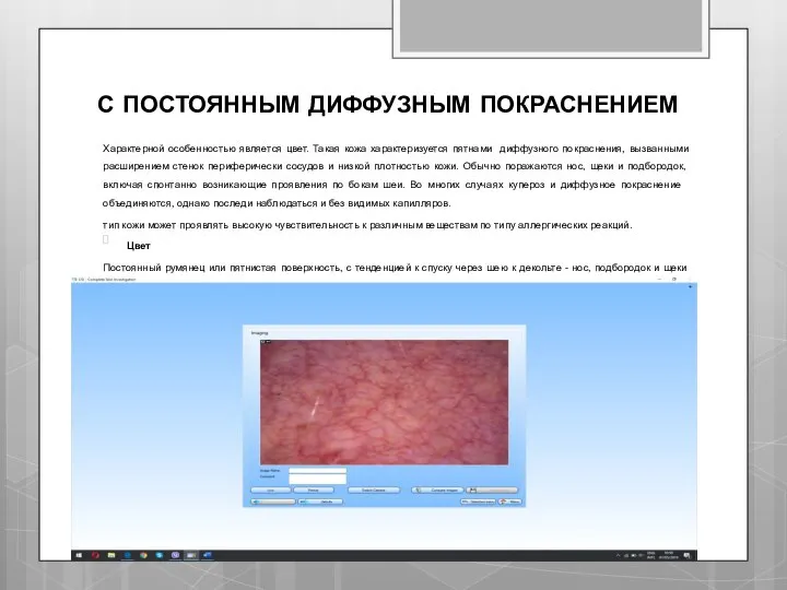С ПОСТОЯННЫМ ДИФФУЗНЫМ ПОКРАСНЕНИЕМ Характерной особенностью является цвет. Такая кожа характеризуется пятнами