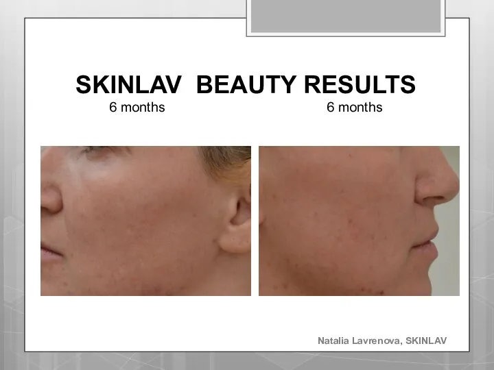 SKINLAV BEAUTY RESULTS 6 months 6 months Natalia Lavrenova, SKINLAV