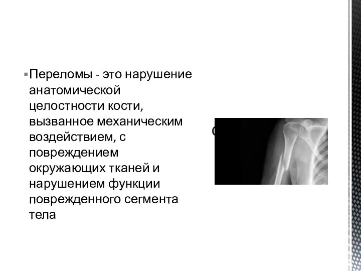 Переломы - это нарушение анатомической целостности кости, вызванное механическим воздействием, с повреждением