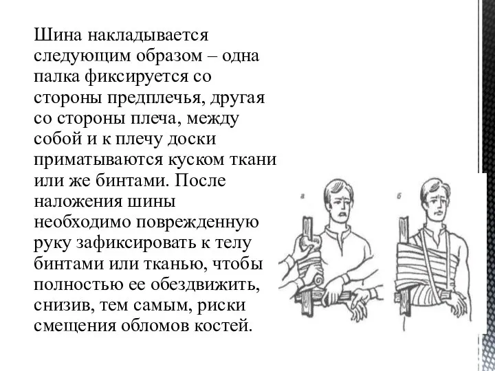 Шина накладывается следующим образом – одна палка фиксируется со стороны предплечья, другая