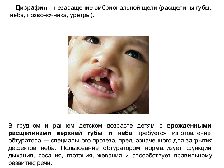 В грудном и раннем детском возрасте детям с врожденными расщелинами верхней губы