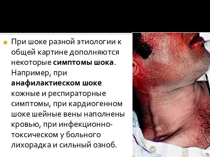 При шоке разной этиологии к общей картине дополняются некоторые симптомы шока. Например,