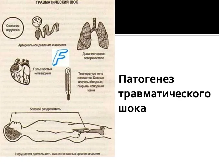 Патогенез травматического шока