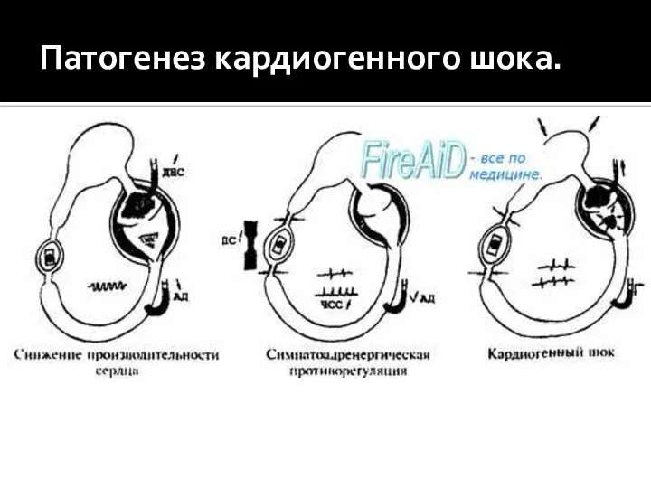 Патогенез кардиогенного шока.