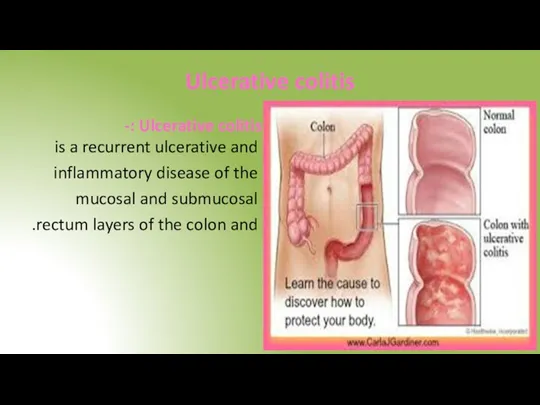 Ulcerative colitis Ulcerative colitis :- is a recurrent ulcerative and inflammatory disease