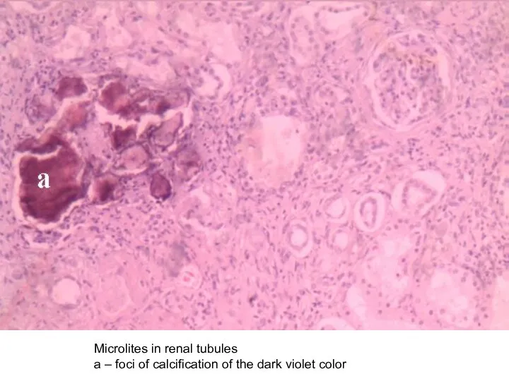 Microlites in renal tubules а – foci of calcification of the dark violet color