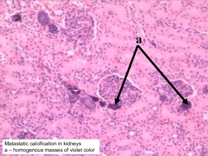 Matastatic calcification in kidneys а – homogenous masses of violet color