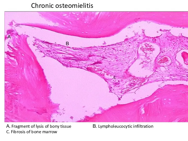 Chronic osteomielitis А. Fragment of lysis of bony tissue В. Lympholeucocytic infiltration