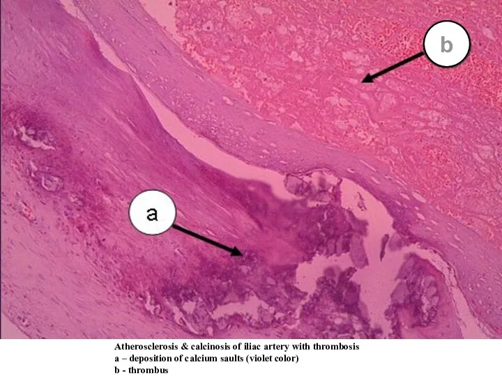 Atherosclerosis & calcinosis of iliac artery with thrombosis а – deposition of