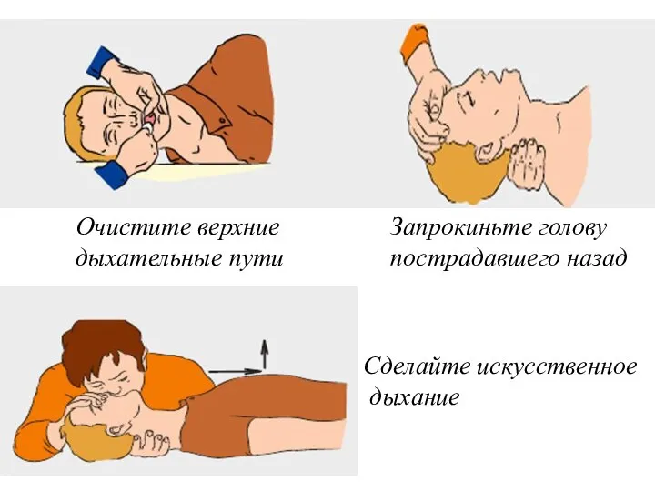 Очистите верхние дыхательные пути Запрокиньте голову пострадавшего назад Сделайте искусственное дыхание