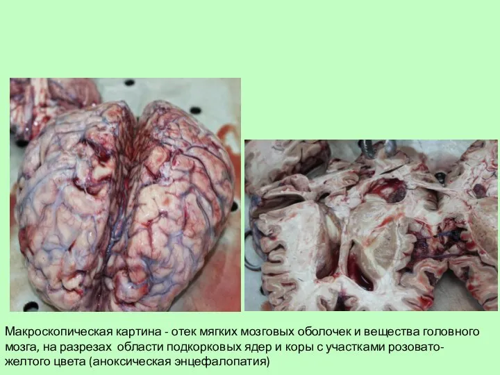 Макроскопическая картина - отек мягких мозговых оболочек и вещества головного мозга, на