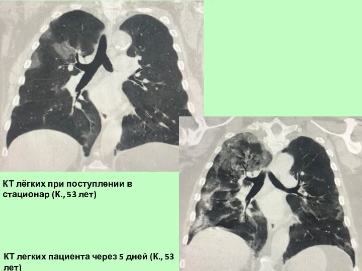 КТ лёгких при поступлении в стационар (К., 53 лет) КТ легких пациента