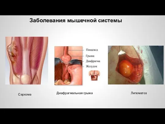 Заболевания мышечной системы Саркома Диафрагмальная грыжа Липоматоз