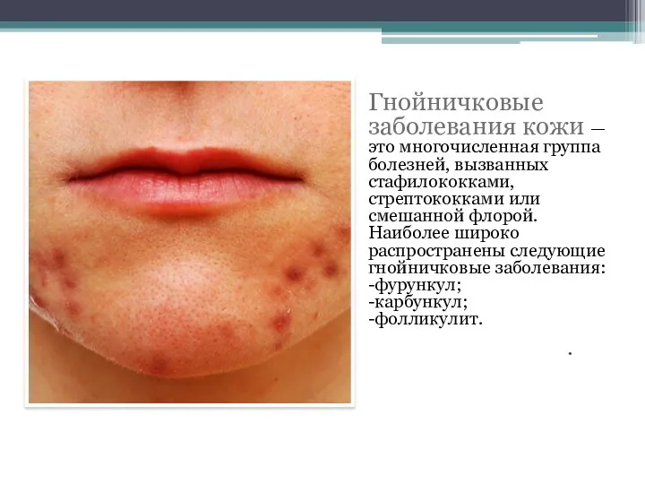 . Гнойничковые заболевания кожи — это многочисленная группа болезней, вызванных стафилококками, стрептококками