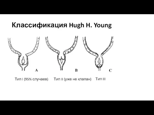 Классификация Hugh H. Young Тип I (95% случаев) Тип II (уже не клапан) Тип III