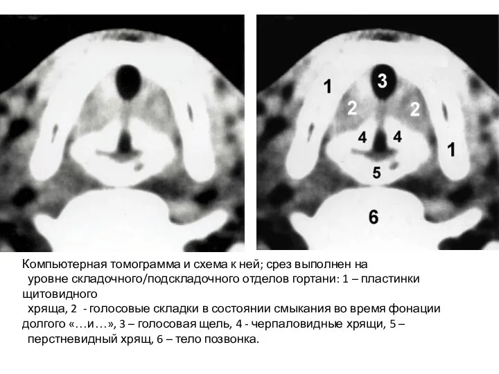 Компьютерная томограмма и схема к ней; срез выполнен на уровне складочного/подскладочного отделов