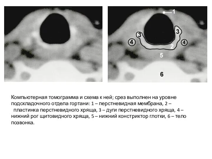 Компьютерная томограмма и схема к ней; срез выполнен на уровне подскладочного отдела