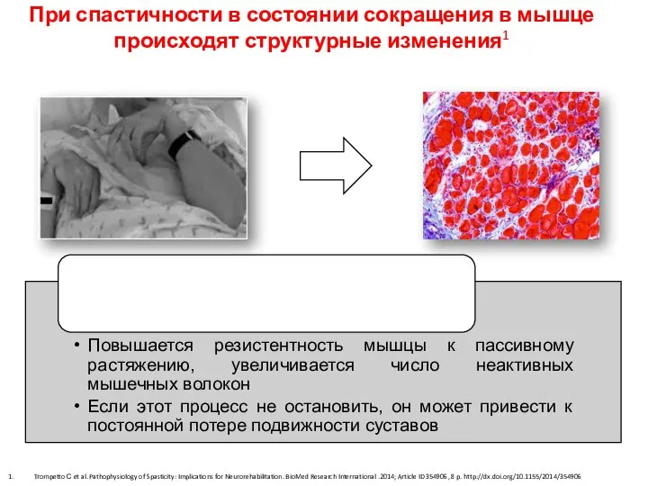 Trompetto С et al. Pathophysiology of Spasticity: Implications for Neurorehabilitation. BioMed Research