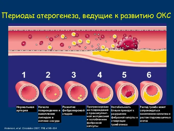 Периоды атерогенеза, ведущие к развитию ОКС Anderson, et al. Circulation 2007; 116;