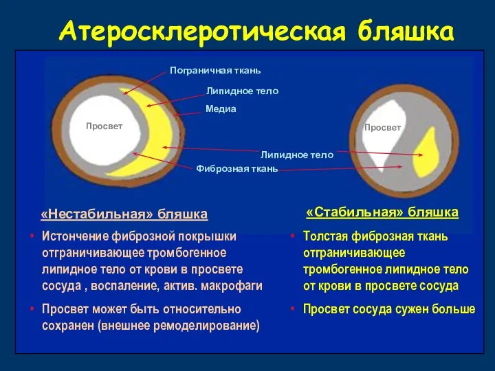 Атеросклеротическая бляшка Липидное тело