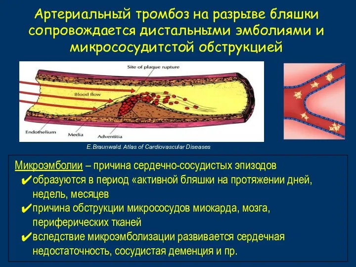 Артериальный тромбоз на разрыве бляшки сопровождается дистальными эмболиями и микрососудитстой обструкцией E.Braunwald.