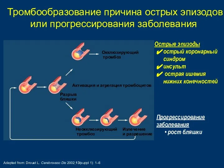 Разрыв бляшки Активация и агрегация тромбоцитов Неокклюзирующий тромбоз Окклюзирующий тромбоз Излечение и