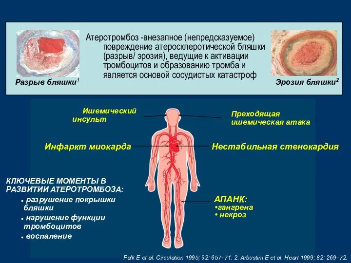 REACH Registry Education Kit Преходящая ишемическая атака Нестабильная стенокардия Ишемический инсульт Инфаркт