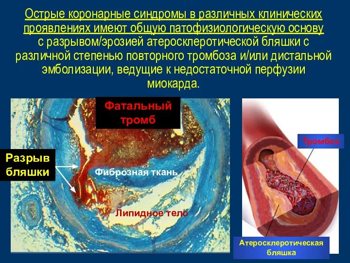 Атеросклеротическая бляшка Тромбоз Фиброзная ткань Липидное тело Фатальный тромб Разрыв бляшки Острые