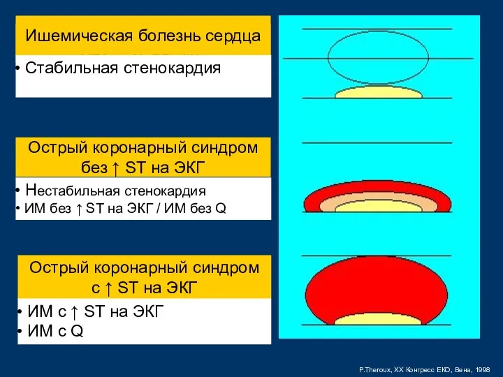 P.Theroux, XX Конгресс ЕКО, Вена, 1998 Острый коронарный синдром без ↑ ST