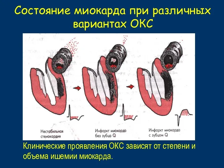 Состояние миокарда при различных вариантах ОКС Клинические проявления ОКС зависят от степени и объема ишемии миокарда.