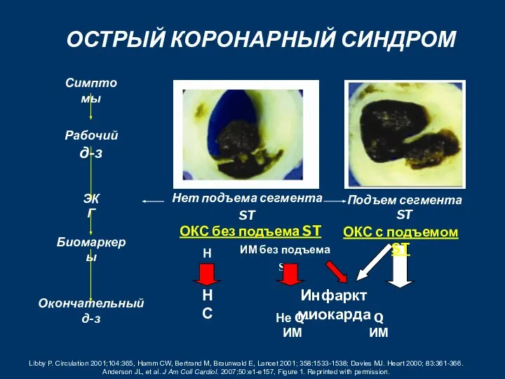 Libby P. Circulation 2001;104:365, Hamm CW, Bertrand M, Braunwald E, Lancet 2001;