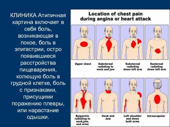 КЛИНИКА Атипичная картина включает в себя боль, возникающая в покое, боль в