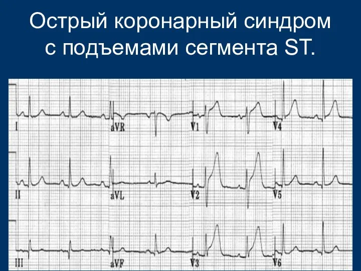 Острый коронарный синдром с подъемами сегмента ST.