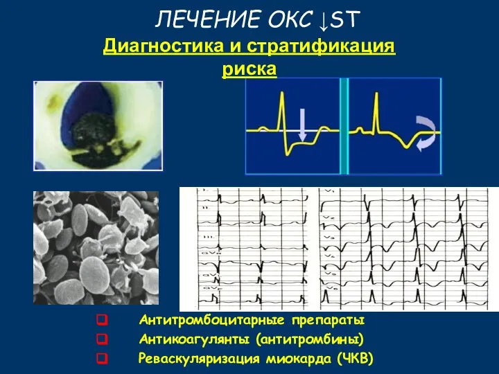 Антитромбоцитарные препараты Антикоагулянты (антитромбины) Реваскуляризация миокарда (ЧКВ) Диагностика и стратификация риска ЛЕЧЕНИЕ ОКС ↓ST