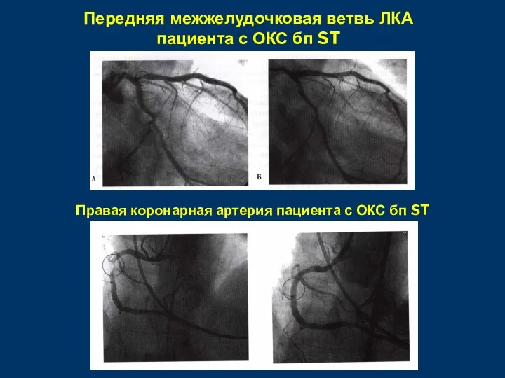 Передняя межжелудочковая ветвь ЛКА пациента с ОКС бп ST Правая коронарная артерия