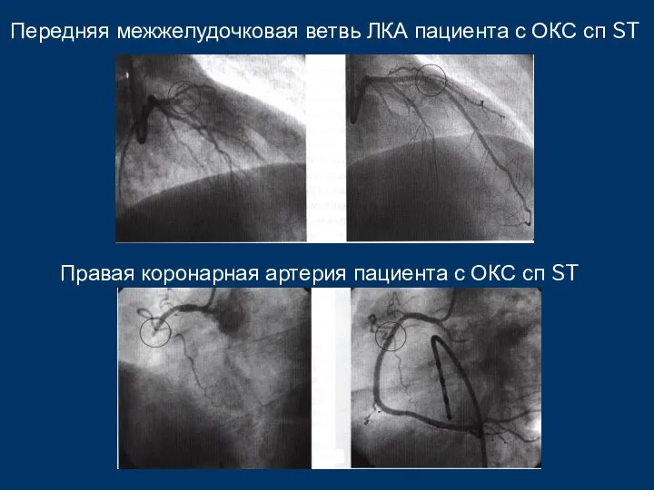 Передняя межжелудочковая ветвь ЛКА пациента с ОКС сп ST Правая коронарная артерия