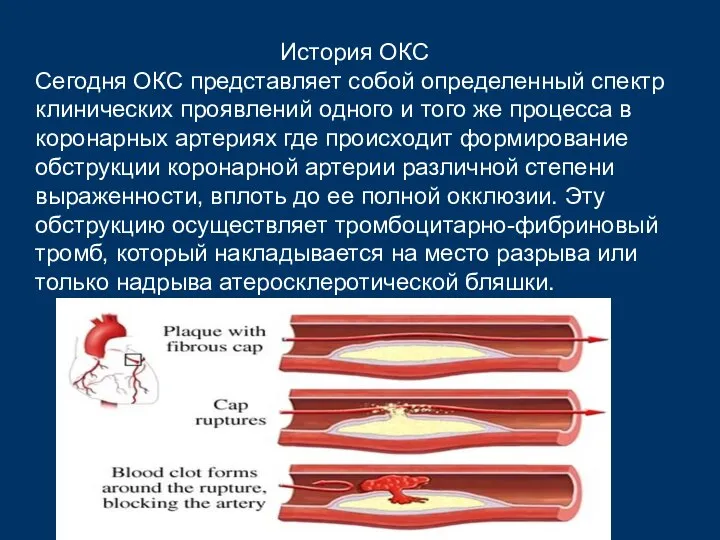 История ОКС Сегодня ОКС представляет собой определенный спектр клинических проявлений одного и