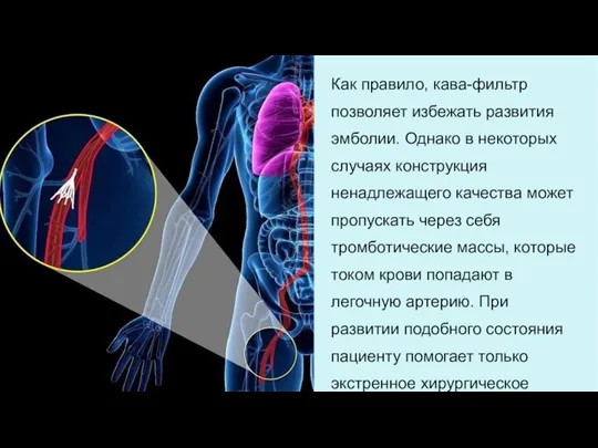 Как правило, кава-фильтр позволяет избежать развития эмболии. Однако в некоторых случаях конструкция